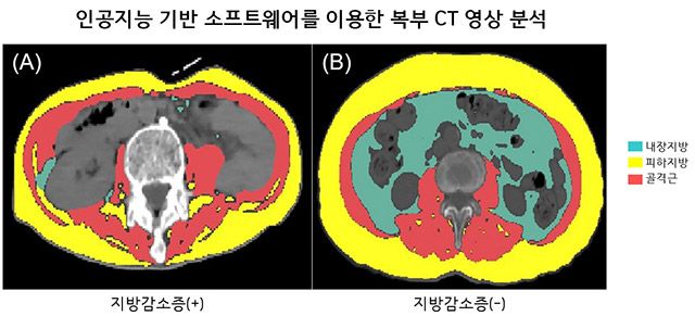 인공지능 기반 소프트웨어로 체성분 분석한 루게릭병 환자의 복부 CT영상. 지방감소증 동반한 환자 (A)는 CT검사 1개월째 사망한 반면, 지방감소증 동반하지 않은 환자 (B)는 35개월(관찰기간) 동안 생존함. /이미지 제공=서울대병원