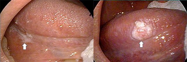 (왼쪽부터) 구강암이 의심되는 지속적인 백반증, 구강암이 의심되는 출혈이 동반되는 궤양 /사진 제공=서울대병원
