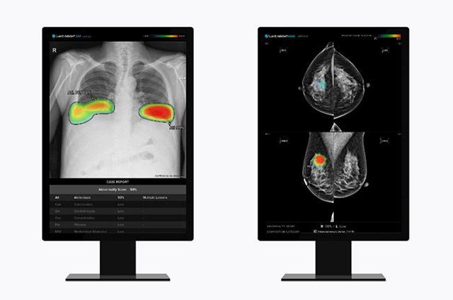 루닛 흉부 엑스레이 AI 영상분석 솔루션 '루닛 인사이트 CXR'(왼쪽)과 유방촬영술 AI 영상분석 솔루션 '루닛 인사이트 MMG' /이미지 제공=루닛