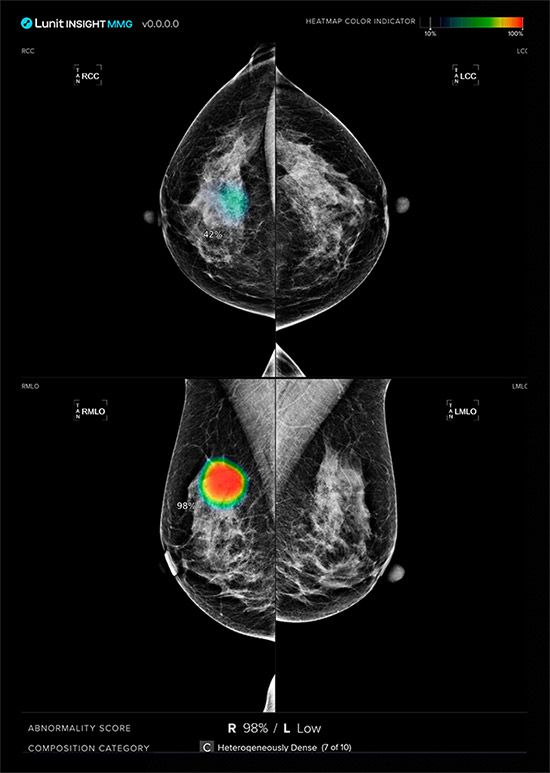 루닛 유방촬영술 AI 영상분석 솔루션 '루닛 인사이트 MMG' /이미지 제공=루닛