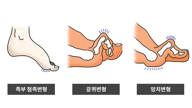 당뇨발 수술이 필요한 경우 /이미지 제공=한림대학교동탄성심병원