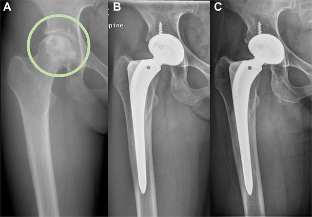 3세대 세라믹 인공고관절 전치환술을 받은 27세 대퇴골두 골괴사 여성의 단순 방사선 사진 /이미지 제공=서울대병원