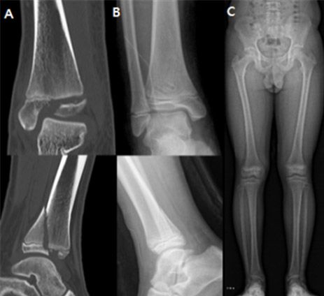 A. 발목 성장판 골절이 발생한 12세 남아 환자의 모습, B. 생체흡수성 나사를 이용해 골절 부위를 고정하는 수술적 치료(고정술)를 시행한 모습, C. 수술 2년 후 성장판 손상 없이 회복된 모습, 성장판 골절로 인해 발생할 수 있는 변형이나 다리 길이 차이 등이 나타나지 않은 것을 확인할 수 있다. /사진 제공=분당서울대병원