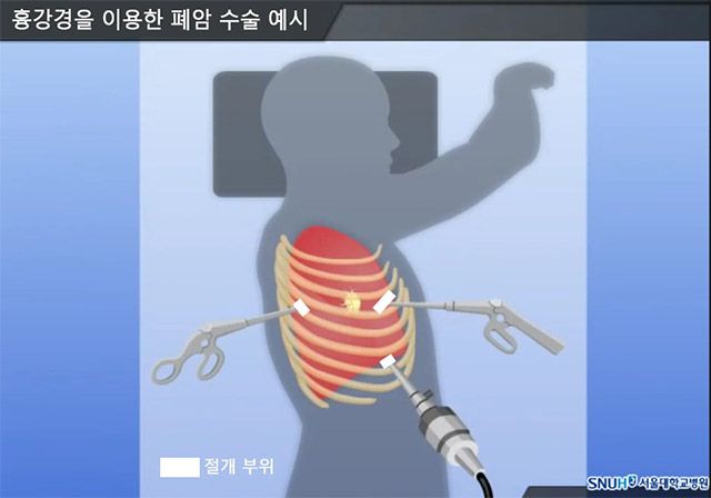 흉강경을 이용한 폐암 수술 예시 /이미지 출처=서울대병원 암정보교육센터