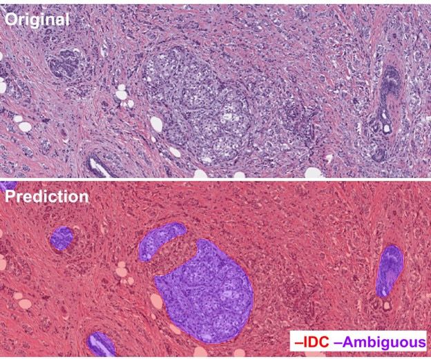 딥바이오-MurSS 모델의 시각화 결과: 침윤성 유관암은 빨간색, 모호한 영역은 보라색으로 구분해 처리했다. /이미지 제공=딥바이오