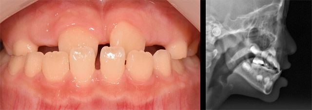 반대교합의 사례 /사진 제공=관악서울대치과병원