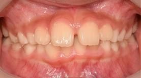 윗 앞니 사이가 벌어져 있는 모습 /사진 제공=관악서울대치과병원