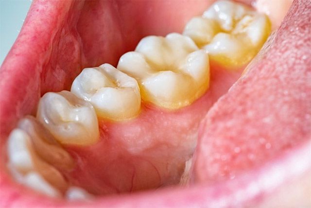 치태(플라크)는 치아 표면에 들러 붙어서 생기는 끈끈하고 투명한 막이다. /사진 제공=서울대치과병원 원스톱협진센터