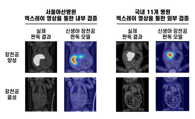 신생아 장천공 인공지능 판독 모델은 복강 내 공기가 차 있는 영역 등을 정확히 식별하며 장천공 여부를 판별했다. /이미지 제공=서울아산병원