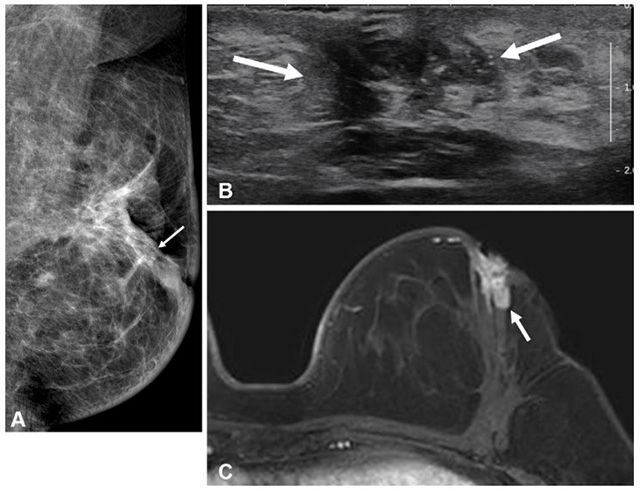 수술 전 MRI 검사를 시행하지 않은 50세 이하 유방암 환자의 수술 2년 후 영상. (A) 유방촬영술, (B) 초음파, (C) MRI. 동측 유방 내 재발 병변(화살표)이 관찰된다. /이미지 제공=서울대병원