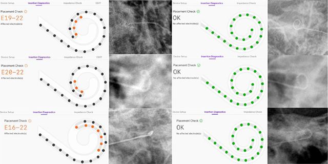 SmartNav가 탐지한 전극 끝말림 확인과 재삽입 후 정상화된 모습. X-ray와 함께 이를 시각적으로 제시했다. /이미지 제공=분당서울대병원