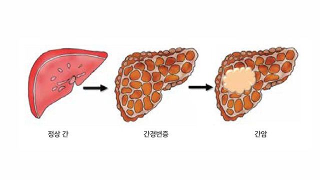 정상 간에서 만성 간질환을 거쳐 간경변으로 진행되는 간 변화 단계. 간 손상이 장기간 누적되면 간암 발생 위험이 높아진다. /이미지 제공=서울대병원