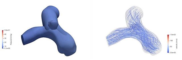 시술 후 합병증 예측을 위한 전산유체역학(CFD) 분석: 압력 분포(왼쪽)와 혈류 흐름(오른쪽) 등을 분석해 시술 후 발생할 수 있는 합병증을 예측한다. /이미지 제공=서울대병원