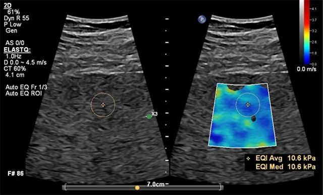 필립스 EPIQ Elite_Auto ElastQ /이미지 제공=필립스코리아