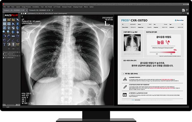 PROS® CXR: OSTEO /이미지 제공=프로메디우스