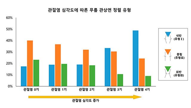 관절염 심각도에 따른 무릎 관상면 정렬 유형. 관절염 0~2기에는 유형Ⅱ(중립 정렬)이 가장 흔했지만, 관절염이 심각해질수록 유형Ⅰ(내반 정렬) 비율이 증가했다. /이미지 제공=서울대병원