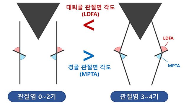 관절염 심각도별 선천적인 무릎 변수 차이. 관절염 3~4기 환자는 0~2기 대비 대퇴골 관절면 각도(LDFA)가 크고 경골 관절면 각도(MPTA)가 작아, 내반 정렬의 특성이 뚜렷했다. /이미지 제공=서울대병원