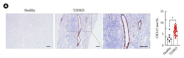 [그림] 당뇨병콩팥병(T2DKD)과 건강한 신장 조직 비교: 당뇨병콩팥병 조직에서는 CXCL12 발현이 증가하며, 특히 T 면역세포가 많이 침투된 부위에서 강하게 나타남. 오른쪽 그래프는 당뇨병콩팥병 환자 그룹이 건강한 그룹에 비해 CXCL12 신장 발현이 증가함을 보여줌. 이는 CXCL12가 당뇨병콩팥병 환자의 신장 염증 진행에 중요한 역할을 한다는 것을 시사함. /이미지 제공=서울대병원