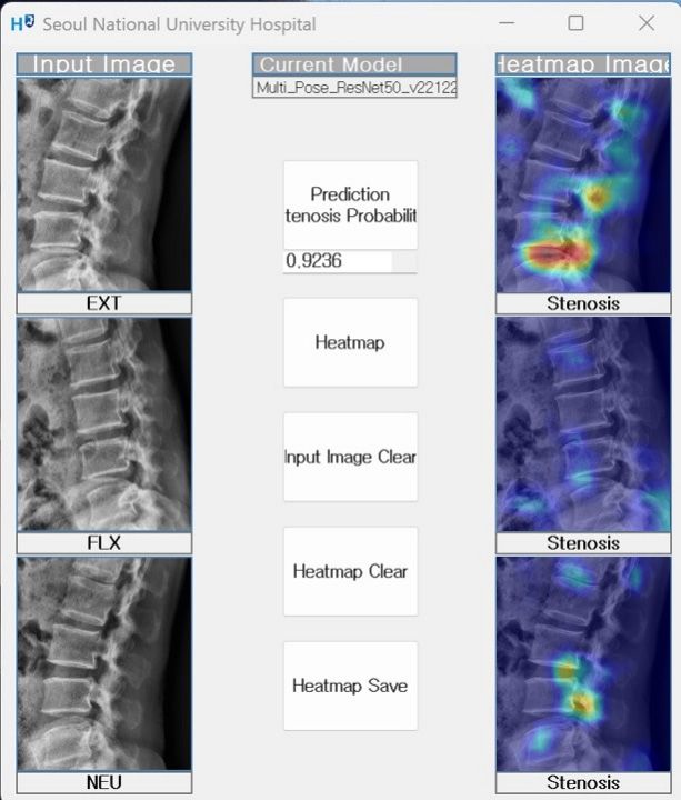 개발한 인공지능 모델을 활용한 요추협착증 진단 예시: 중립, 굴곡, 신전 자세에서 촬영된 X선 사진을 바탕으로 인공지능 모델이 요추협착증을 예측하고, 히트맵으로 예측 근거를 시각적으로 제공한다.(병변 부위 붉게 표시) /이미지 제공=서울대병원