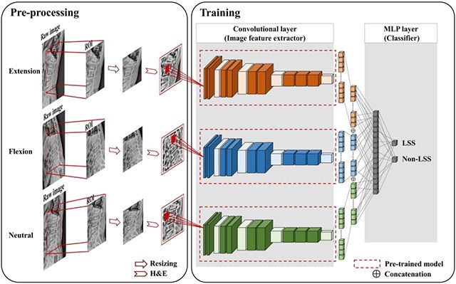 다중 자세 X선 사진을 기반으로 AI 모델이 요추협착증(LSS)을 분류하는 작업 흐름: 세 가지 자세에서 추출된 특징을 결합해 요추협착증을 진단한다. /이미지 제공=서울대병원