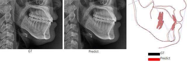 (왼쪽부터) AI가 예측한 수술 후 영상, 실제 수술 후 영상, 두 영상 간 차이를 보여주는 이미지 /이미지 제공=서울아산병원