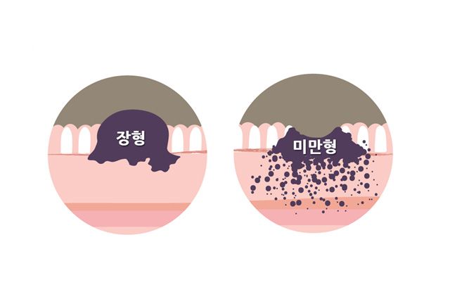 위암의 형태에 따른 분류. 미만형 위암은 점막을 따라 퍼지듯 분포되어 조기 발견이 어렵고 예후도 좋지 않다. /이미지 제공=분당서울대병원