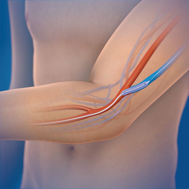 메드트로닉의 IN.PACT AV DCB. 풍선 표면에 파클리탁셀이 코팅되어 혈관 재협착을 막는 제품으로 기존 PTA에 비해 혈관 재확장 시술 빈도를 절반 넘게 줄일 수 있다. /이미지 제공=메드트로닉