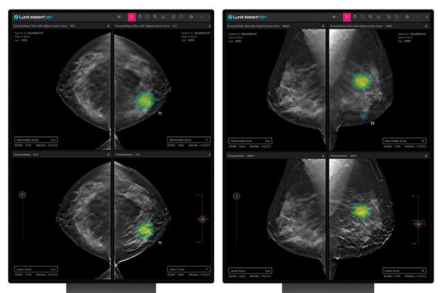 Lunit INSIGHT DBT /이미지 제공=루닛