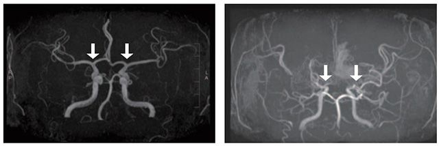 (왼쪽부터) 정상인 및 모야모야병 환자의 뇌혈관 /사진 제공=서울대병원