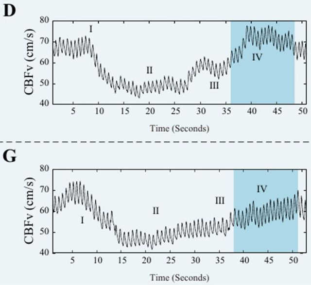 과관류증후군 발생 환자(G)와 그렇지 않은 환자(D)의 뇌혈류 속도 비교. 발살바호흡을 통해 동맥혈압이 낮아졌다가 정상으로 되돌아갈 때(Ⅳ구간), 과관류증후군 발생 환자는 그렇지 않은 환자보다 뇌혈류 속도가 서서히 증가하고, 뇌혈관 반응성이 떨어지는 것으로 나타났다. /이미지 제공=서울대병원
