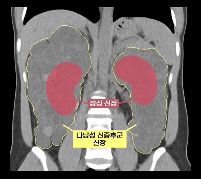실제 다낭성 신증후군 환자의 신장과 정상 신장 비교 /이미지 제공=서울아산병원