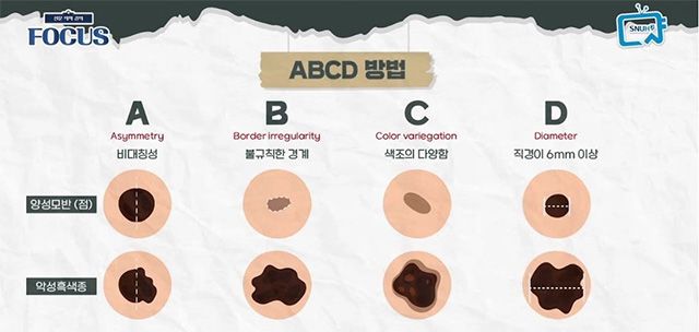 악성흑색종 조기 발견을 위한 ‘ABCD 자가진단 체크포인트’. 비대칭성, 경계 불규칙성, 색조 다양성, 직경 기준을 기억하는 것이 중요하다. /이미지 제공=서울대병원