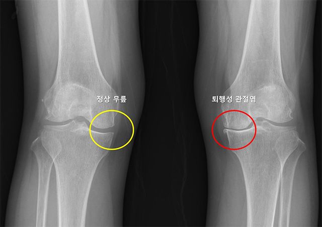 X-ray 이미지. 정상 무릎(노란색)은 관절 간격이 잘 유지되고 뼈 모양이 정상이며, 퇴행성 관절염(빨간색)은 관절 간격이 좁아지고 뼈 모양이 변형됨. /이미지 제공=서울대병원