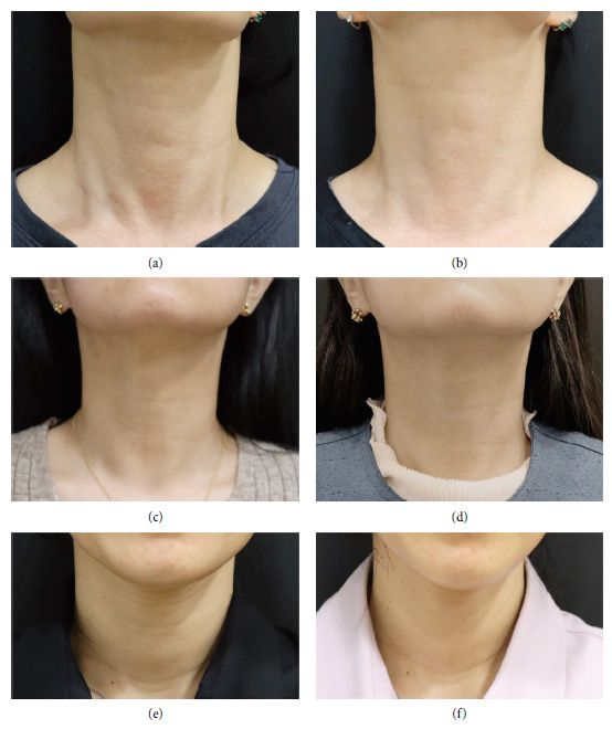 CaHA 필러 시술 전후(4주)의 목 주름 개선 사례. 시술 직후 4주까지의 피부 탄력 및 주름 개선 효과가 관찰됐다. /이미지 출처=박귀영 외, Dermatologic Therapy, 2024