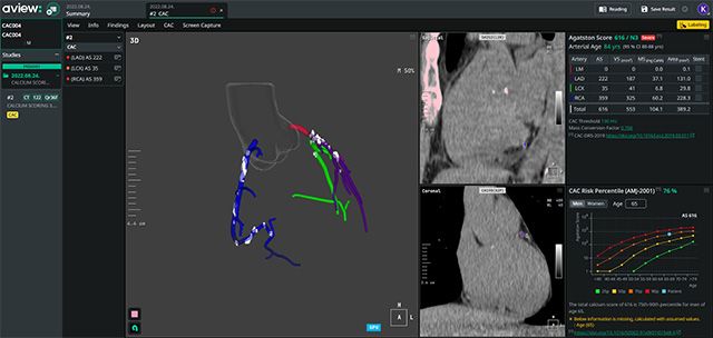 AVIEW CAC /이미지 제공=코어라인소프트
