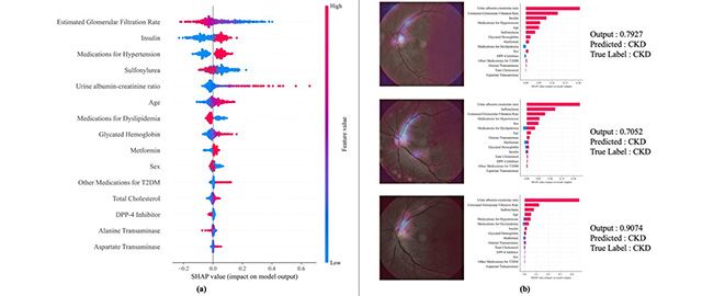 설명 가능한 AI 분석 결과. (a) 주요 임상 변수의 영향력 시각화. (b) 망막 이미지 기반 개별 예측 사례에서 AI가 중요하게 판단한 영역과 예측 확률. 세 경우 모두 실제로 CKD가 발생한 환자임을 보여준다. /이미지 제공=경희대 연구팀