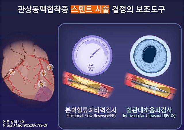 관상동맥 스텐트 시술에 활용되는 대표적 검사 방법. 혈류량을 측정하는 분획혈류예비력(FFR)과 혈관 상태를 관찰하는 혈관내초음파(IVUS). /이미지 제공=서울대병원
