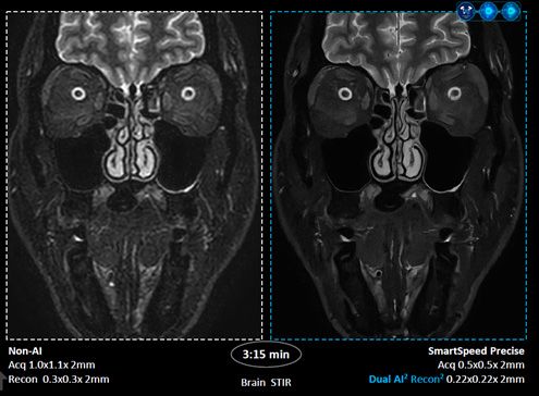 좌측은 기존 방식(Non-AI), 우측은 ‘SmartSpeed Precise’를 적용한 뇌 STIR 영상 /이미지 제공=필립스코리아