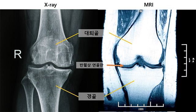 (왼쪽부터)엑스레이 및 MRI 무릎 사진 /출처=게티이미지뱅크(서울대병원 제공)