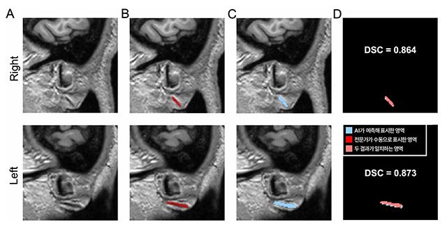 3차원 원본 이미지(A)를 토대로 전문가가 수동으로 직접 표시한 주름(B)과 AI가 예측해 자동으로 표시한 영역(C) /이미지 제공=분당서울대병원
