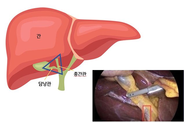 담낭절제삼각 위치 개념도(좌)와 실제 담낭절제술 중 영상인식 AI가 담낭절제삼각을 식별해 표시한 화면(우). 해당 AI는 집도의의 구조 인식을 보조하는 용도로 활용되고 있다. /이미지 제공=한림대동탄성심병원