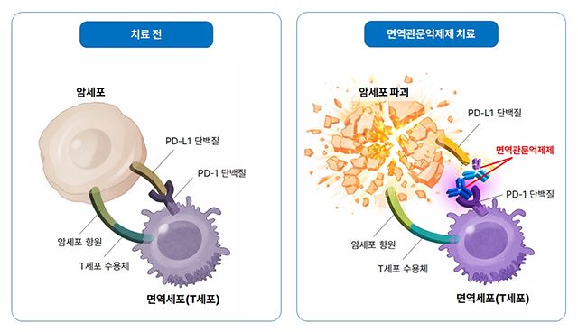 면역관문억제제는 암세포가 면역세포의 공격을 회피하는 PD-L1–PD-1 신호를 차단해 T세포의 항암 반응을 활성화하는 치료법이다. /이미지=분당서울대병원