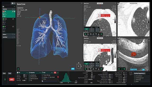 폐 CT 영상을 분석하는 코어라인소프트의 인공지능(AI) 솔루션 화면. /이미지=코어라인소프트