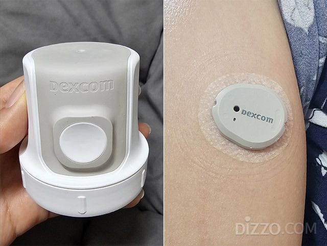 연속혈당측정기(CGM) 기기(왼쪽)와 팔에 센서를 부착한 모습. /사진=김정아 기자