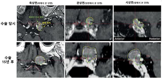 시신경 인접 수막종 환자의 MRI 영상. 시신경 보호를 위해 일부 종양에 방사선을 조사하지 않았던 부위에서 장기 추적 중 종양이 다시 확인됐다. /이미지=서울대병원