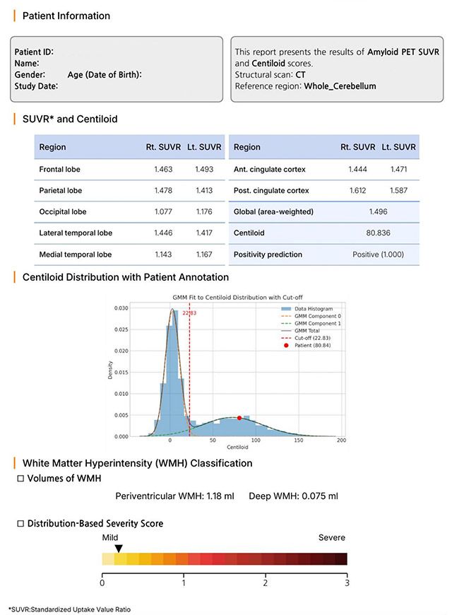AI 기반 아밀로이드 PET 정량분석 리포트 예시. 환자별 아밀로이드 축적 정도를 수치로 확인할 수 있다. /이미지=한림대학교성심병원