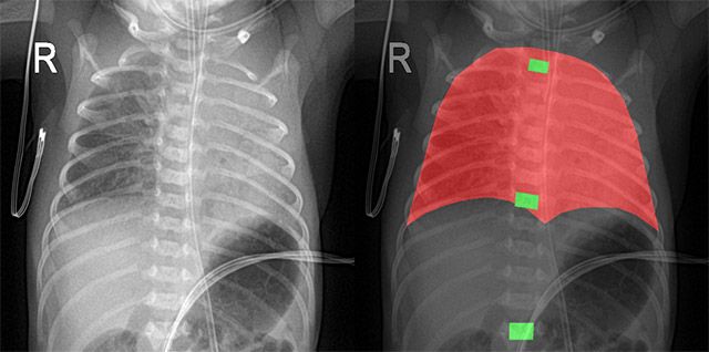 신생아 흉부 X-ray(왼쪽)와 AI를 활용한 흉추 기준점 자동 인식 결과(오른쪽) /이미지=코어라인소프트