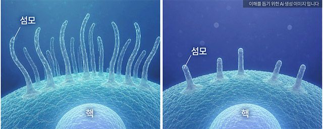 자폐 관련 유전자 쌍 중 하나만 변이된 경우(왼쪽)와 두 유전자가 함께 변이된 경우(오른쪽)의 세포 표면 섬모(cilia) 형성 차이를 나타낸 개념도. 연구팀은 두 유전자의 기능을 동시에 억제했을 때 섬모 형성이 감소하는 현상을 세포실험에서 확인했다. /이미지=분당서울대병원