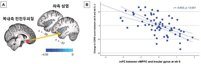 치료 전 복내측 전전두피질(vMPFC)과 좌측 섬엽 간 기능적 연결성(rsFC)이 높을수록 8주 후 소아청소년 우울 증상 평가척도(CDRS-R) 점수 감소 폭이 큰 것으로 나타났다(r=-0.603, p<0.001). /서울대병원 제공