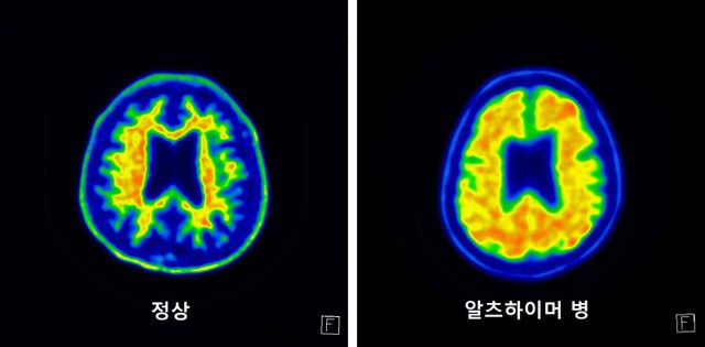 아밀로이드 축적을 관찰한 ‘아밀로이드 PET’ 영상. (좌) 정상 뇌 , (우) 알츠하이머병.